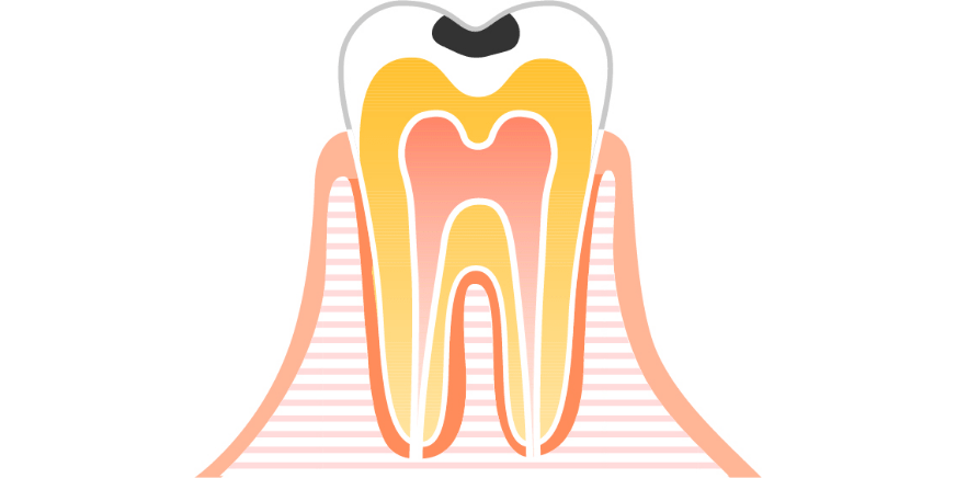 虫歯の初期段階