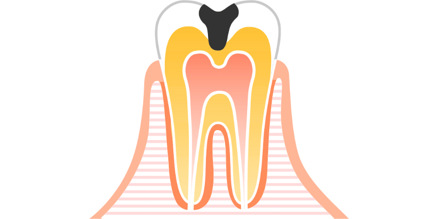エナメル質内の虫歯