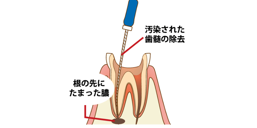 歯の内部の処置
