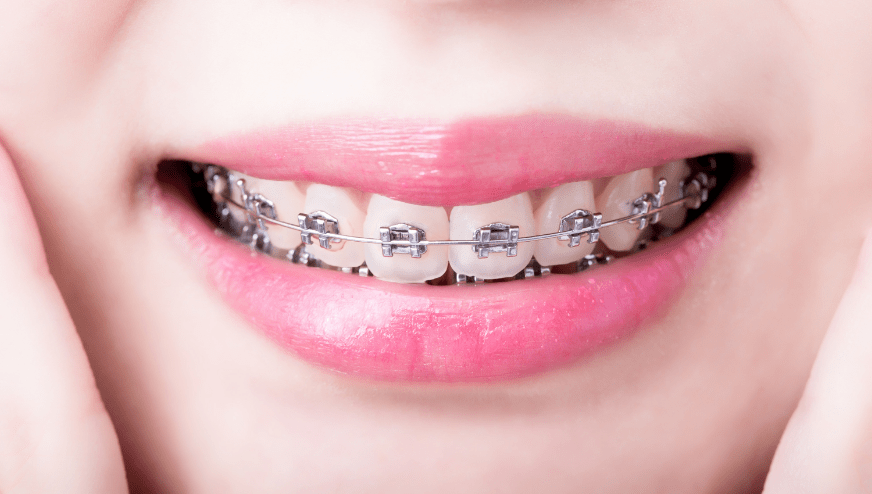 矯正歯科とはどのような治療？