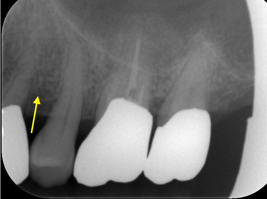 歯周組織再生療法後