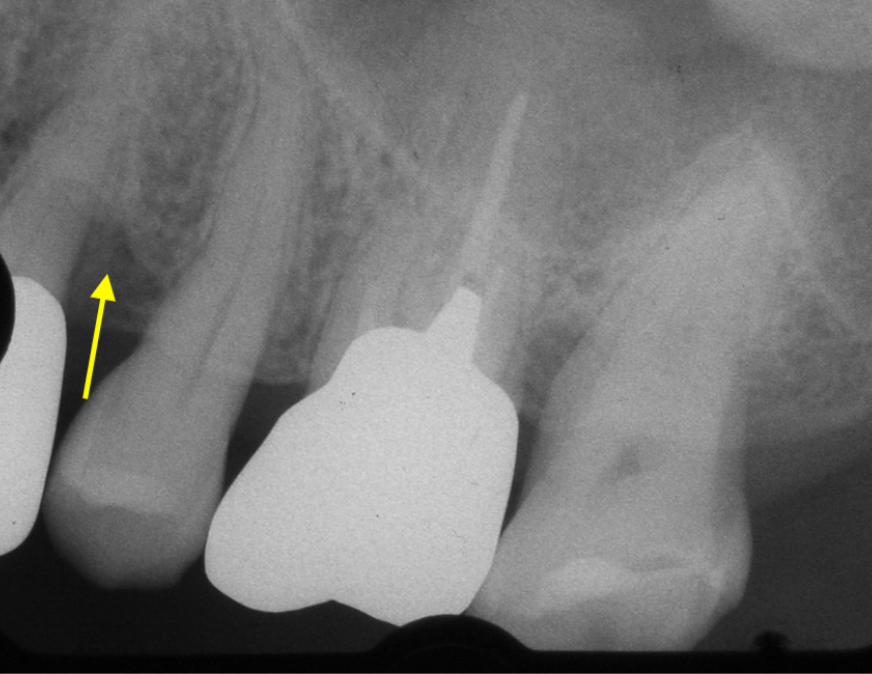歯周組織再生療法前